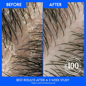 Head & Shoulders almond oil close-up highlighting moisturizing scalp benefit