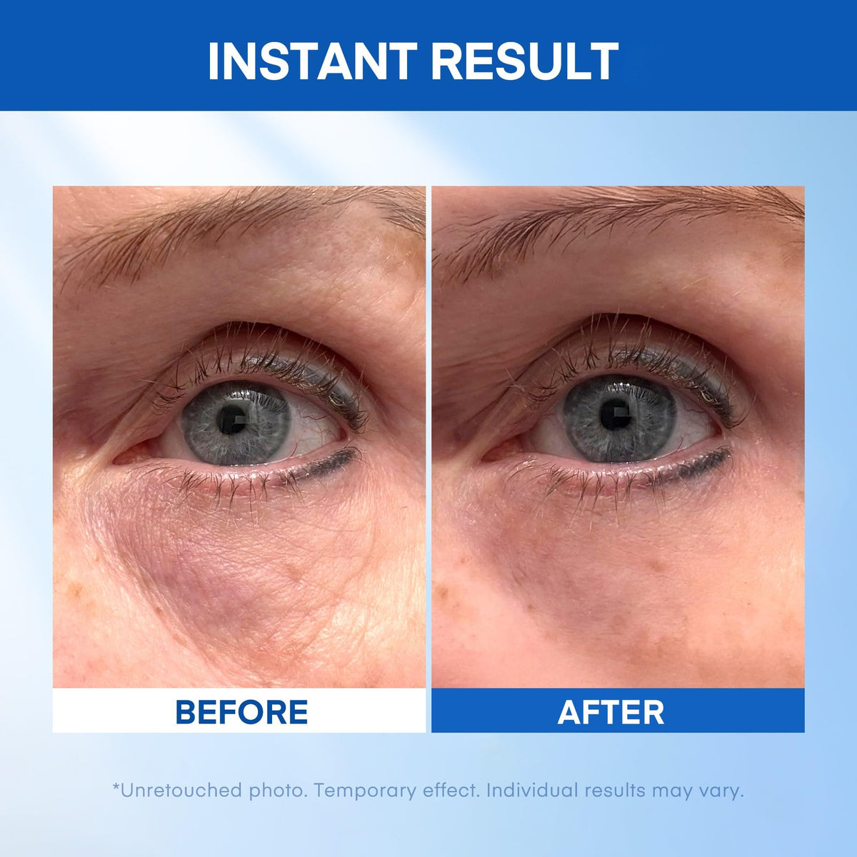HealthyDerm before and after under-eye showing reduced puffiness