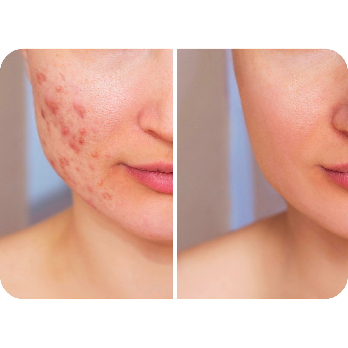 HypoClear being misted near eyelids showing gentle, safe application