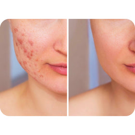 HypoClear being misted near eyelids showing gentle, safe application