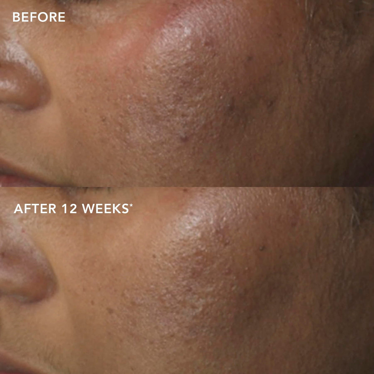 IMAGE Skincare before and after illustration showing improved tone benefit