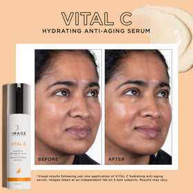 IMAGE Skincare VITAL C paired with a hyaluronic filler showing boosted hydration routine