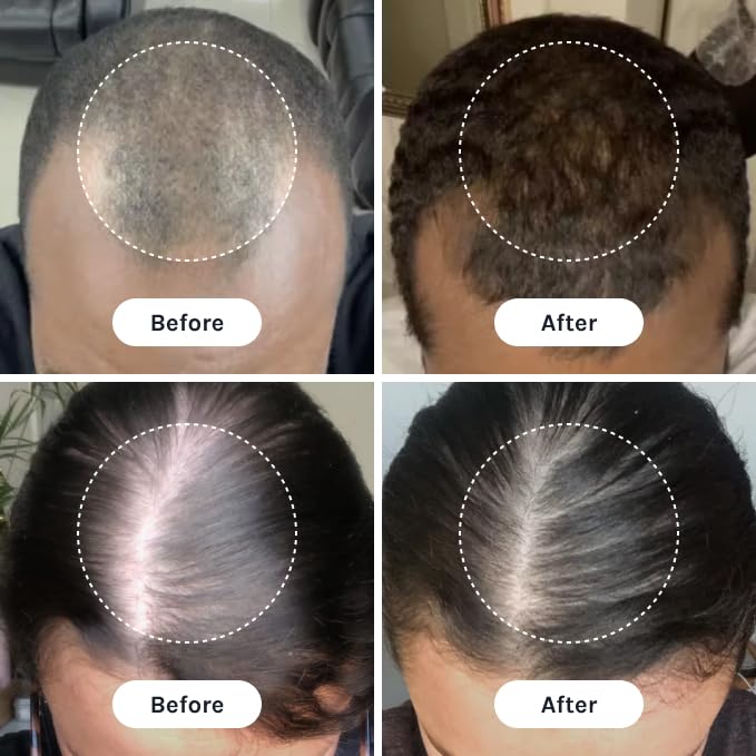 InfiniWell applied to scalp in demo to illustrate targeted delivery and better coverage
