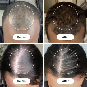 InfiniWell applied to scalp in demo to illustrate targeted delivery and better coverage