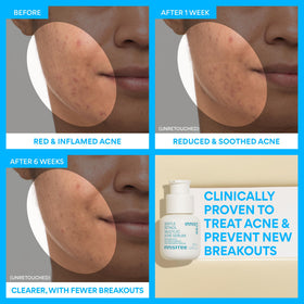 innisfree application on cheek demonstrating targeted blemish treatment benefit