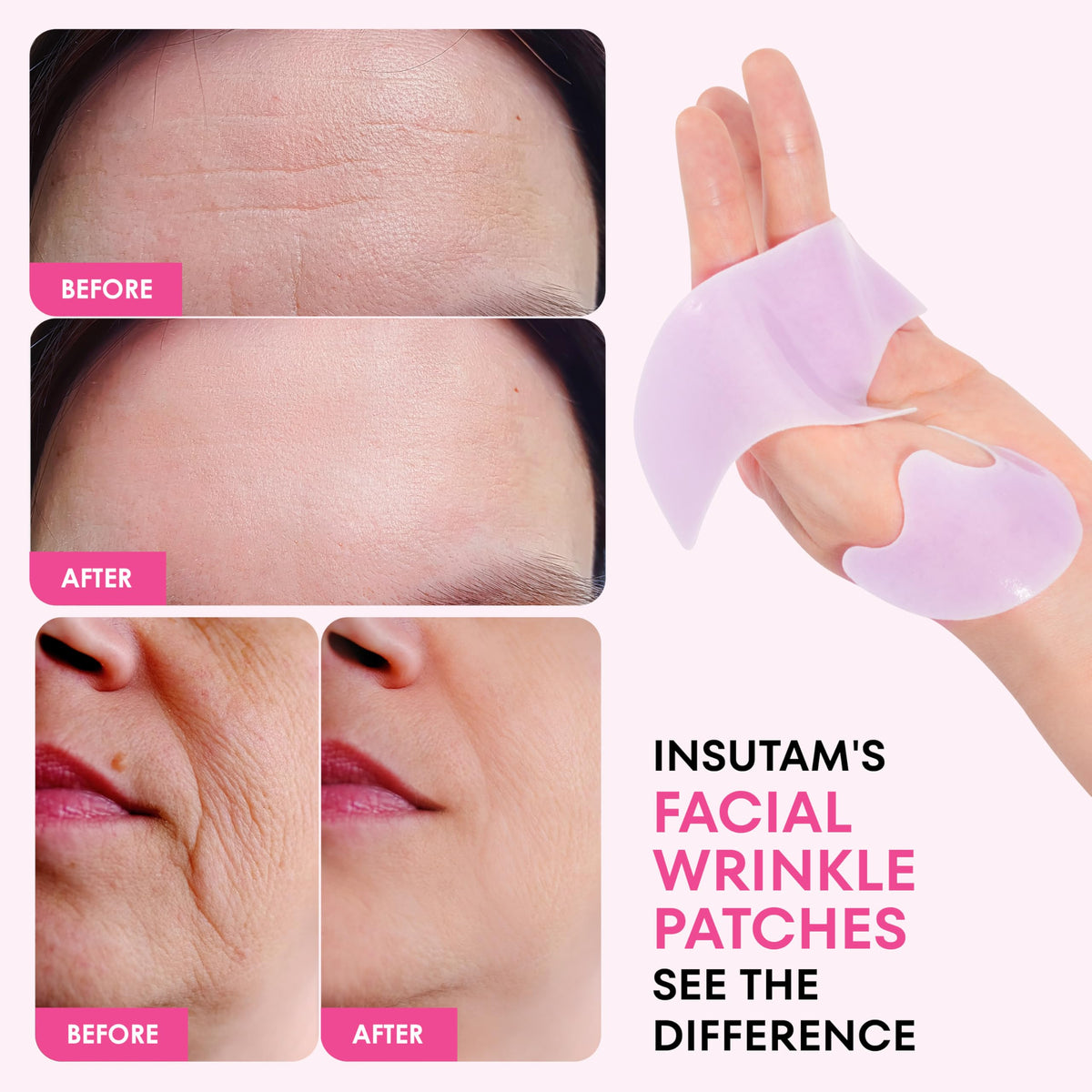 Insutam patch placed on smile line demonstrating targeted smoothing benefit