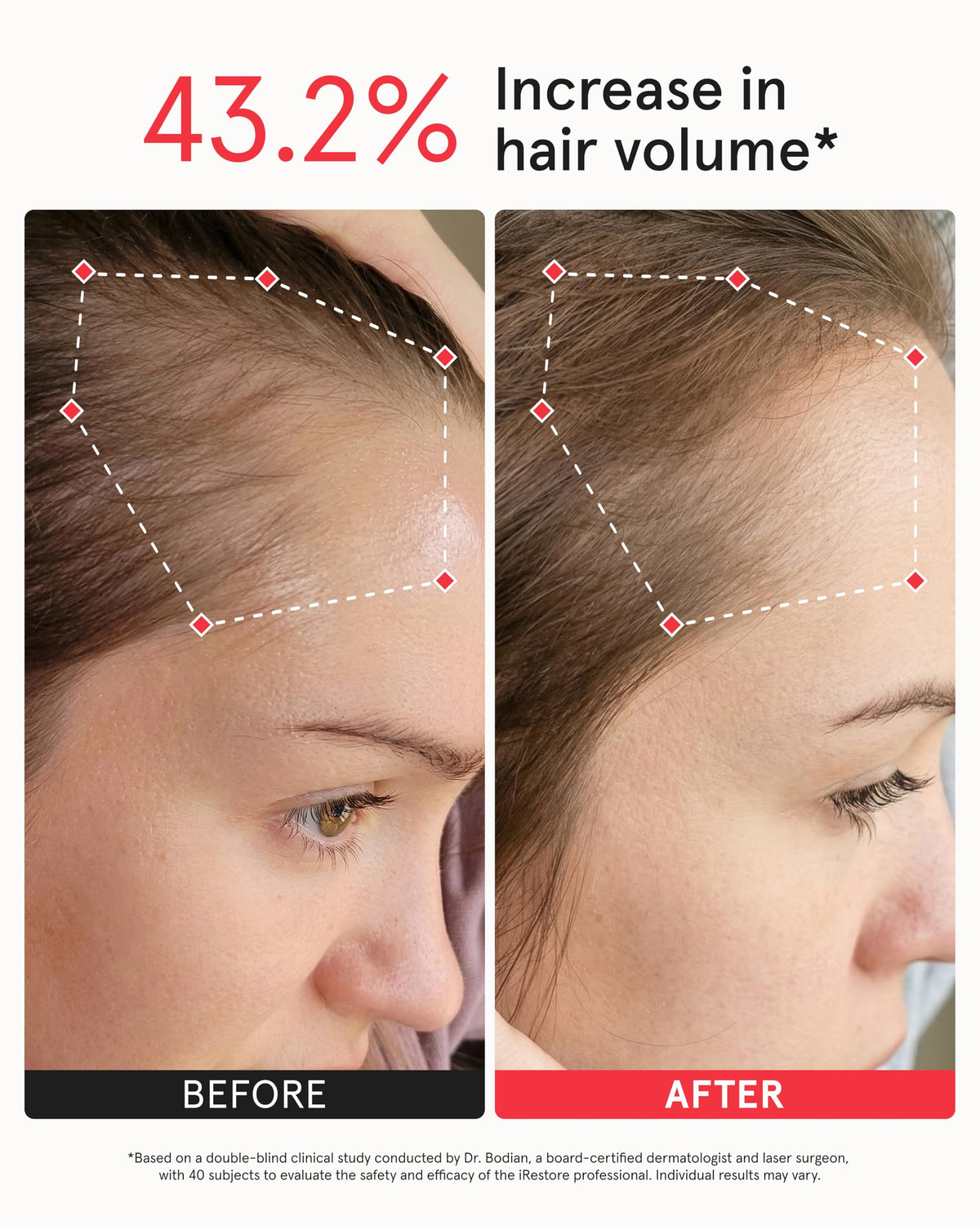 iRestore on head to illustrate size and full scalp coverage benefit