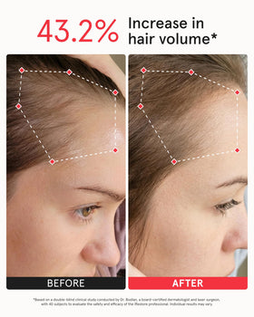iRestore on head to illustrate size and full scalp coverage benefit