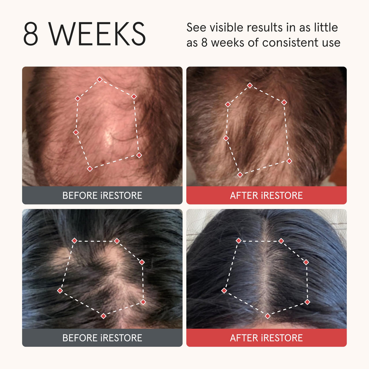 iRestore label close-up highlighting biotin and Redensyl ingredients