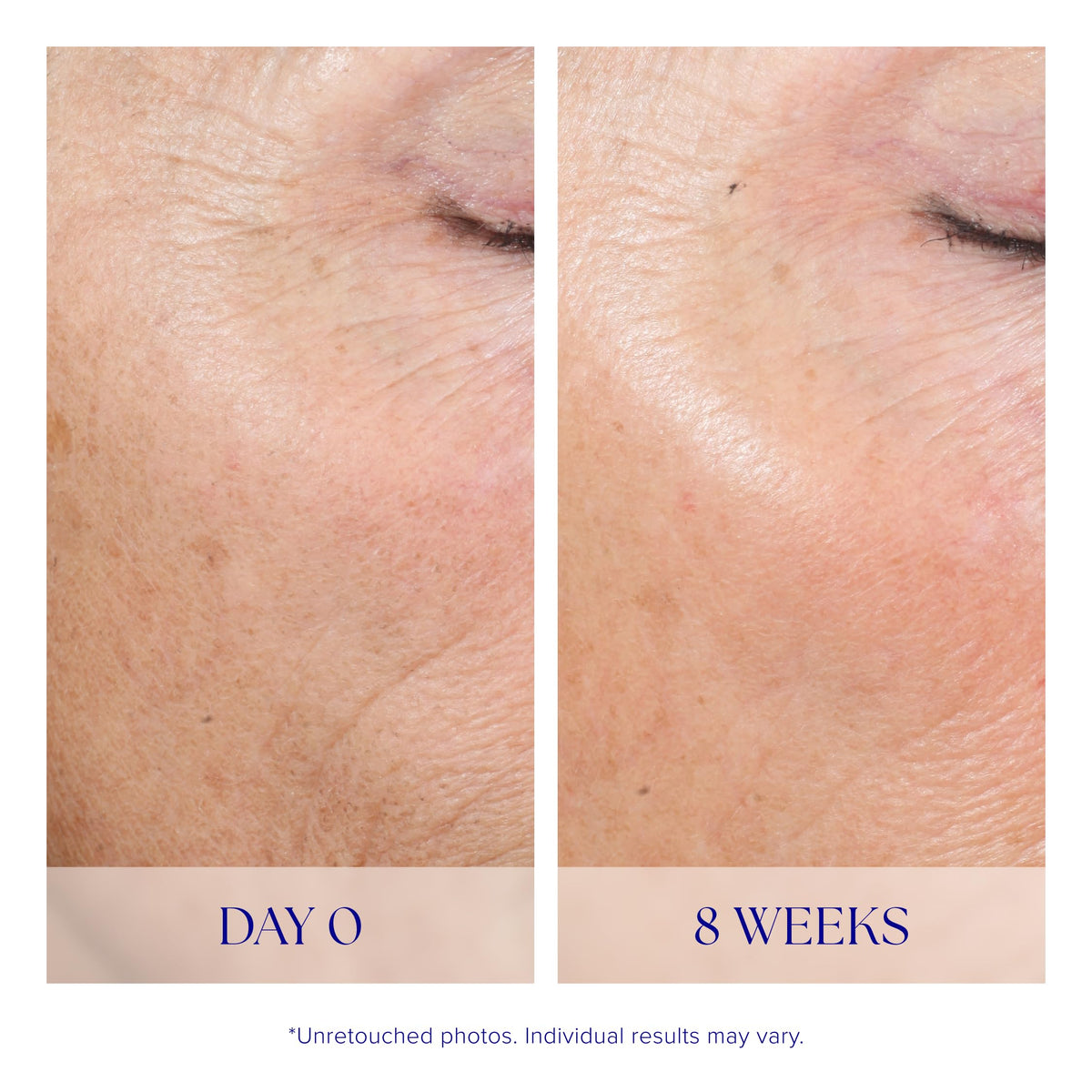 iS CLINICAL product being applied to face illustrating safe at-home resurfacing