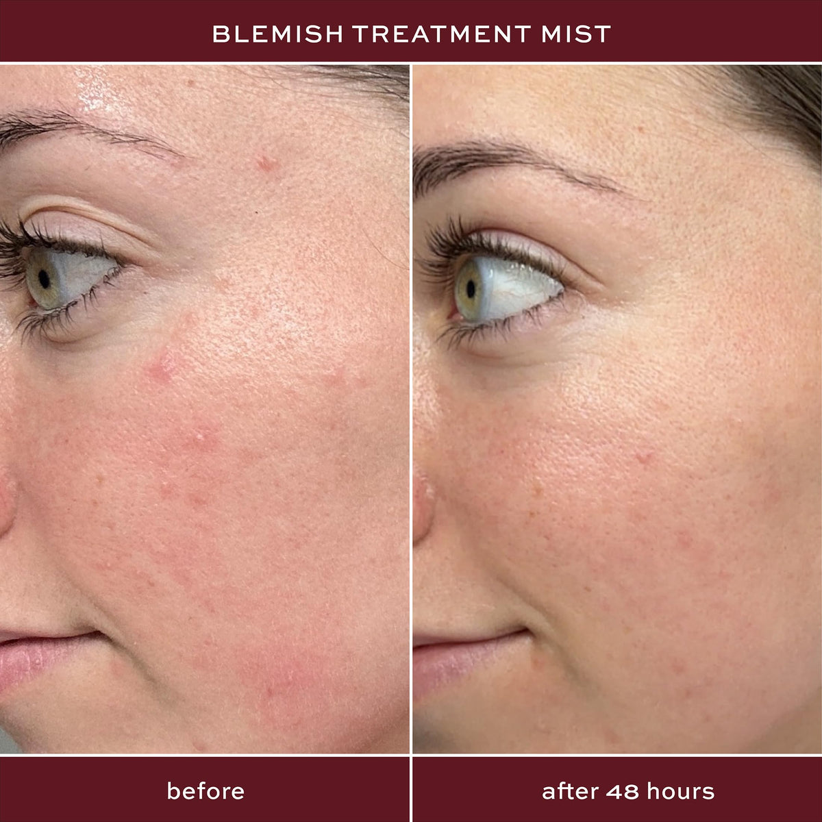 ITK salicylic acid spray nozzle close-up demonstrating easy targeted application