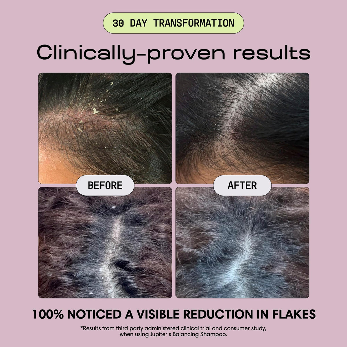 Jupiter serum dropper applying to scalp for targeted relief benefit