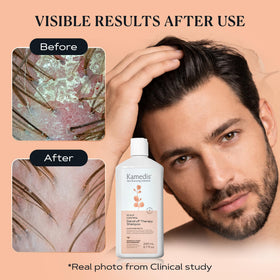 KAMEDIS before-and-after scalp comparison showing reduced flaking