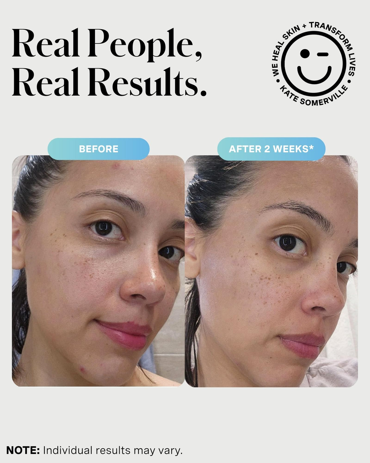 Kate Somerville EradiKate applied as short-contact mask on cheek for targeted treatment