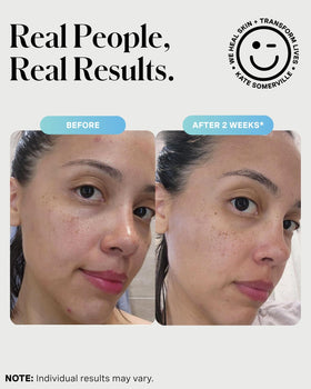 Kate Somerville EradiKate applied as short-contact mask on cheek for targeted treatment