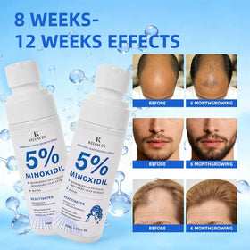 KELUAL DS application on scalp demonstrating targeted treatment benefit