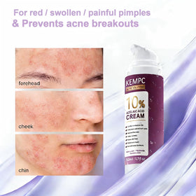 Kempc cream on fingertip demonstrating small-amount spot application for pimples