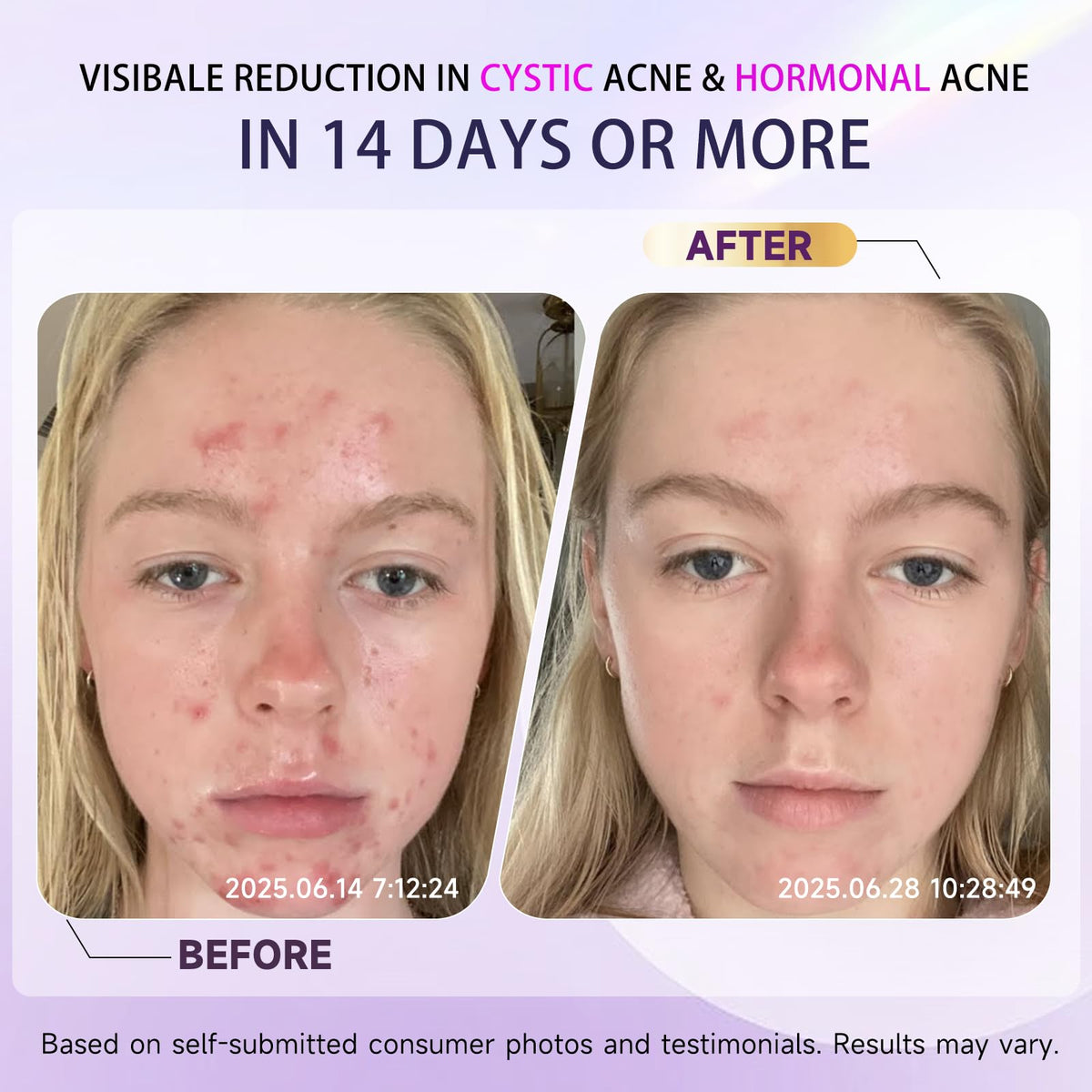 Kempc ingredient label with azelaic and salicylic acids listed for targeted treatment benefit
