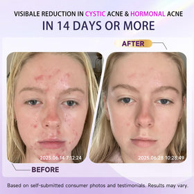 Kempc ingredient label with azelaic and salicylic acids listed for targeted treatment benefit