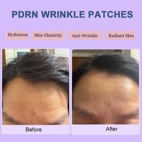 Kewhunt patch applied on forehead demonstrating overnight smoothing benefit