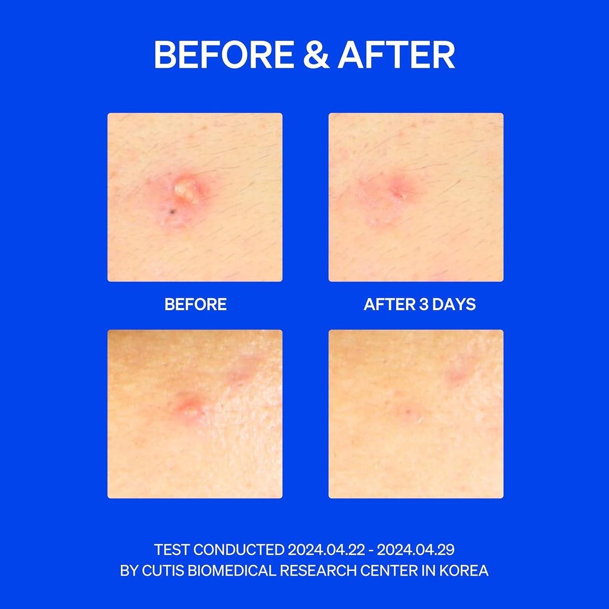 KNEMO patch on face demonstrating discreet wear under makeup