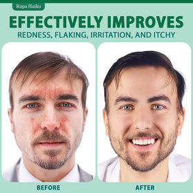 KOPA HAIKU applied to scalp patch showing targeted soothing action