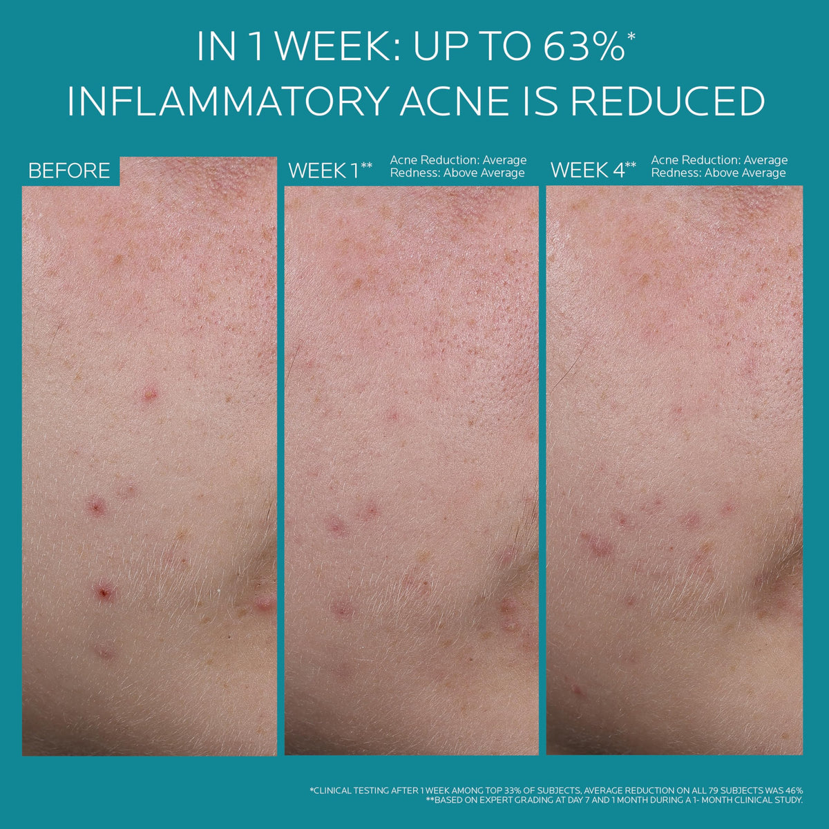 La Roche-Posay ingredient label close-up highlighting 5.5% benzoyl peroxide benefit