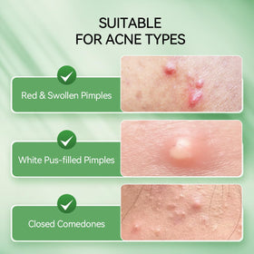 LANBENA applying small dot on fingertip for precise overnight spot treatment