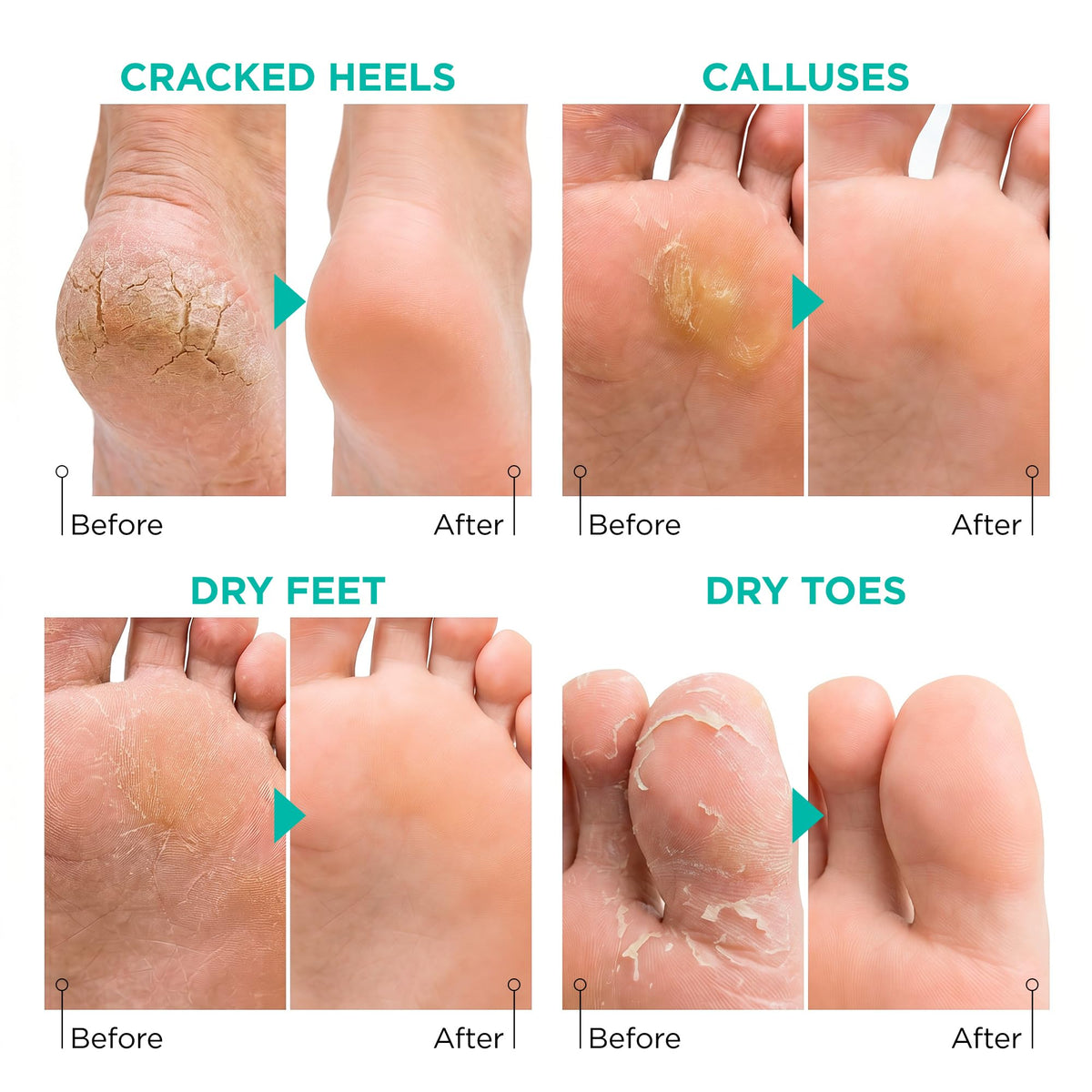 lavinso before and after comparison of heels showing softer skin after treatment benefit