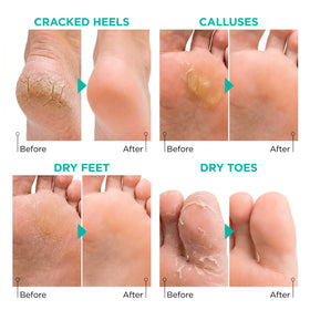 lavinso before and after comparison of heels showing softer skin after treatment benefit