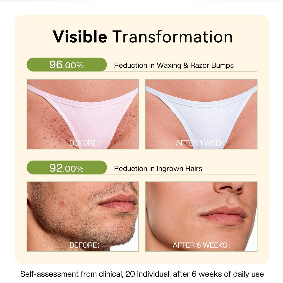 LHOPEBK Nature application on bikini area, soothes razor bumps benefit