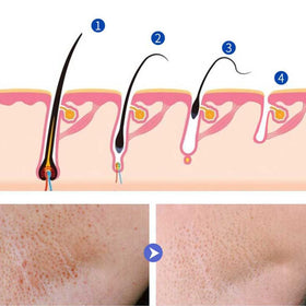 LINEDSON applied to chin area showing gentle post-removal care and reduced regrowth benefit