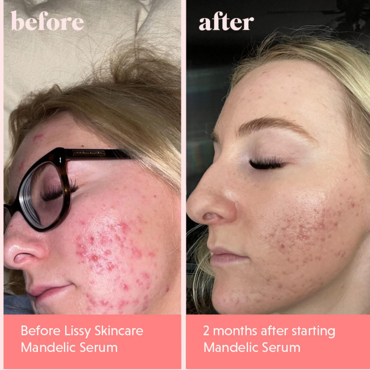 lissy skincare ingredient flatlay featuring licorice root and hyaluronic acid benefits