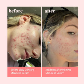 lissy skincare applied to face in lifestyle shot demonstrating calm hydration