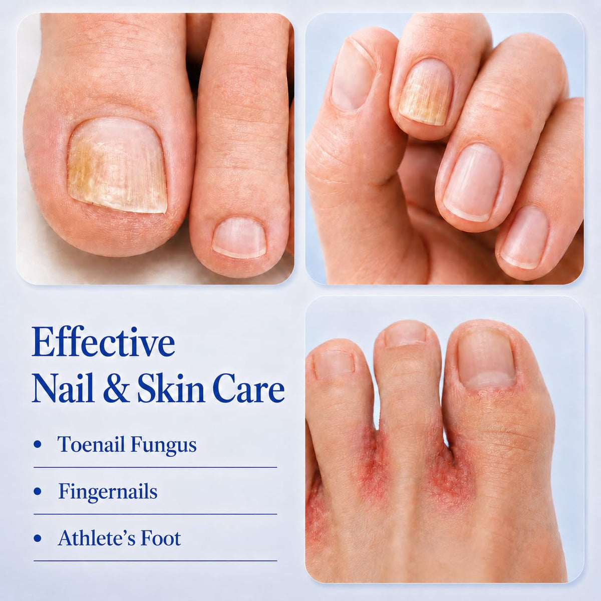 Lyssera pen applying treatment to toenail for cleaner nail appearance