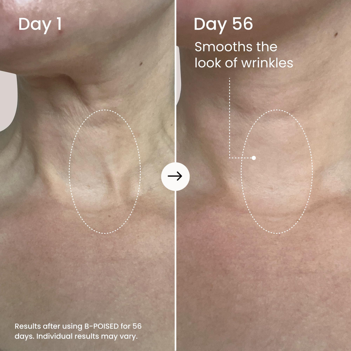 MAËLYS being applied to neck demonstrating lifting motion and smoother look