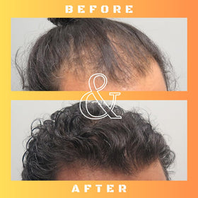 Mane Regain scalp application in use on thinning area illustrating focused DHT-blocking benefit