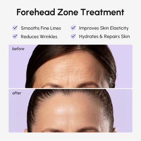 MAREE patch applied between eyebrows demonstrating targeted wrinkle smoothing