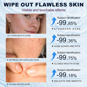 Marianp applying cream to cheek demonstrating targeted acne and redness relief