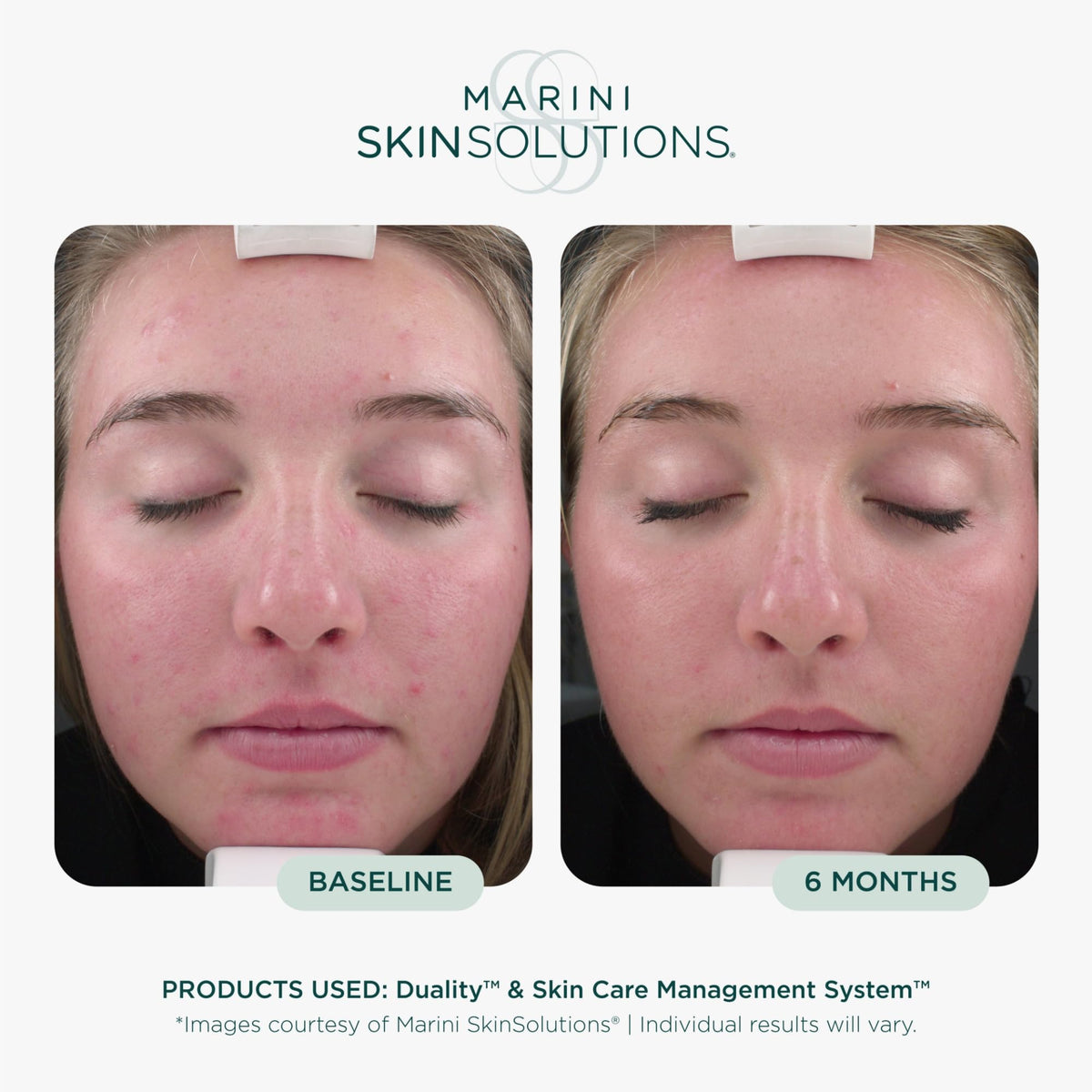 Marini SkinSolutions cream texture close-up showing smooth blend for even application