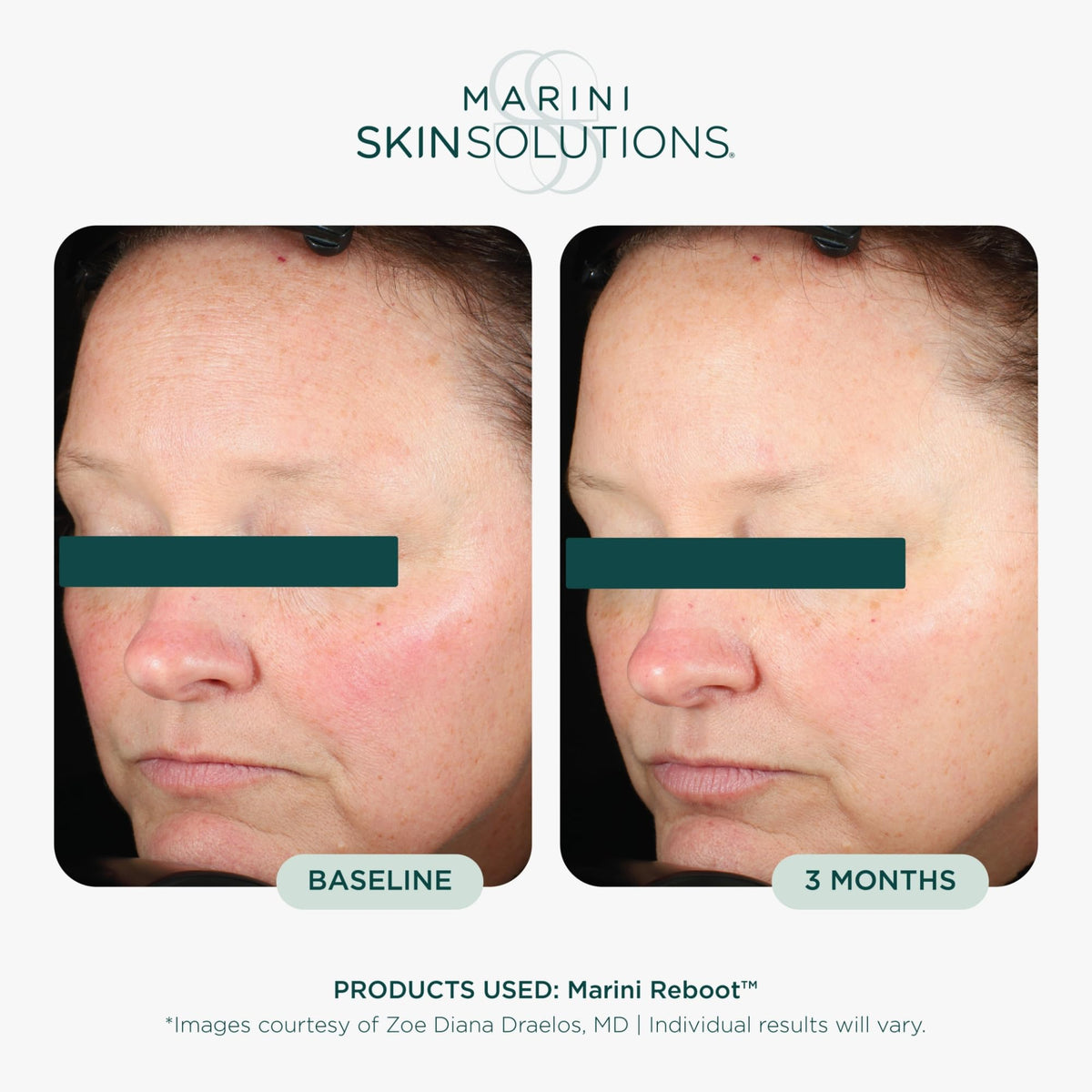 Marini SkinSolutions dropper dispensing a precise drop for targeted application