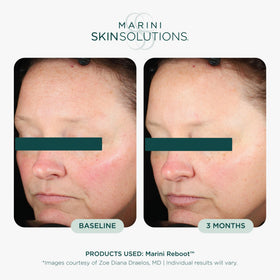 Marini SkinSolutions dropper dispensing a precise drop for targeted application
