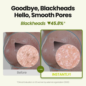 MAXCLINIC before and after showing reduced visible blackheads