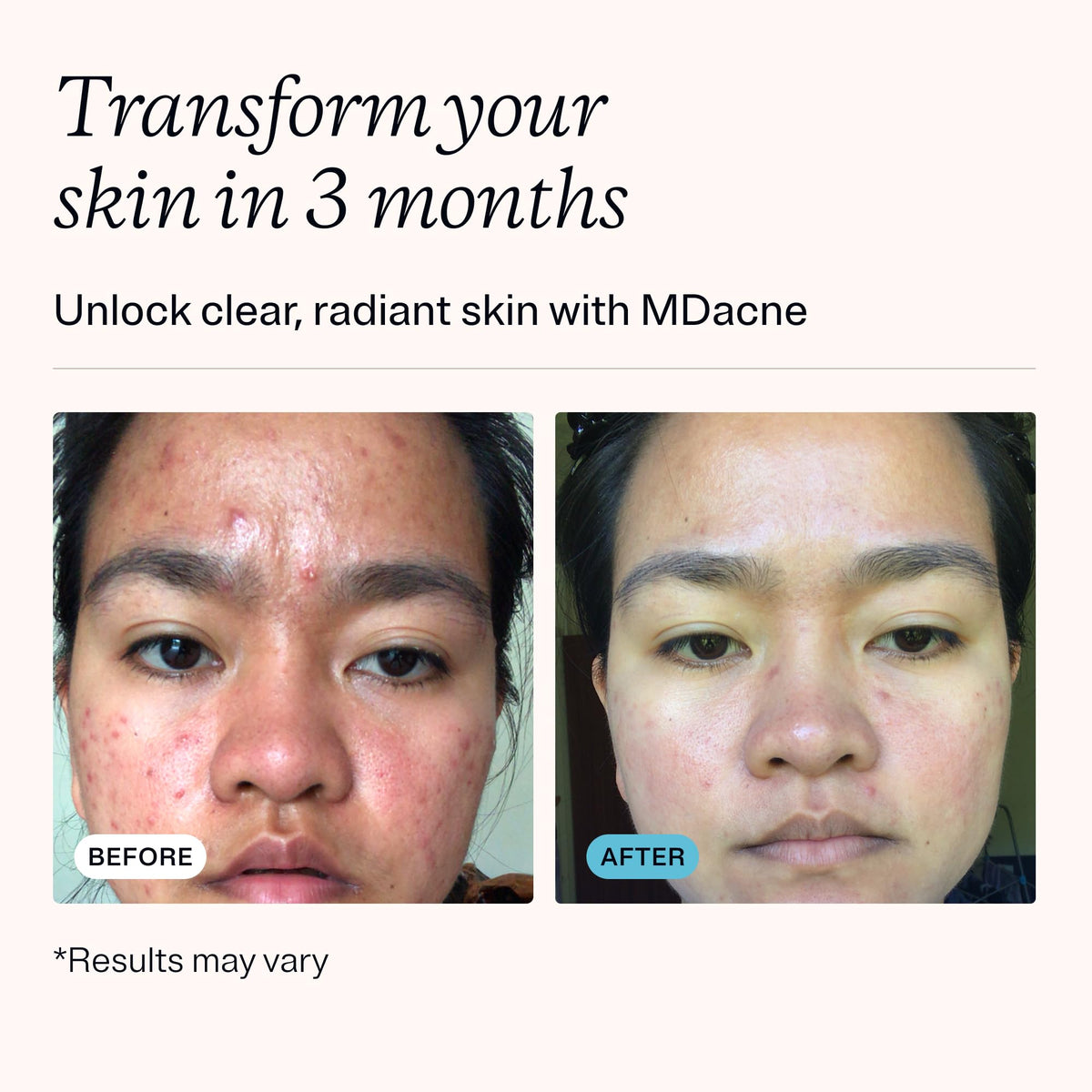 MDacne benzoyl peroxide cream tube close-up reduces active pimples