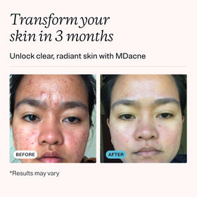 MDacne benzoyl peroxide cream tube close-up reduces active pimples