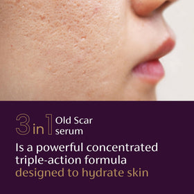 Mederma applied to facial scar demonstrating targeted smoothing benefit