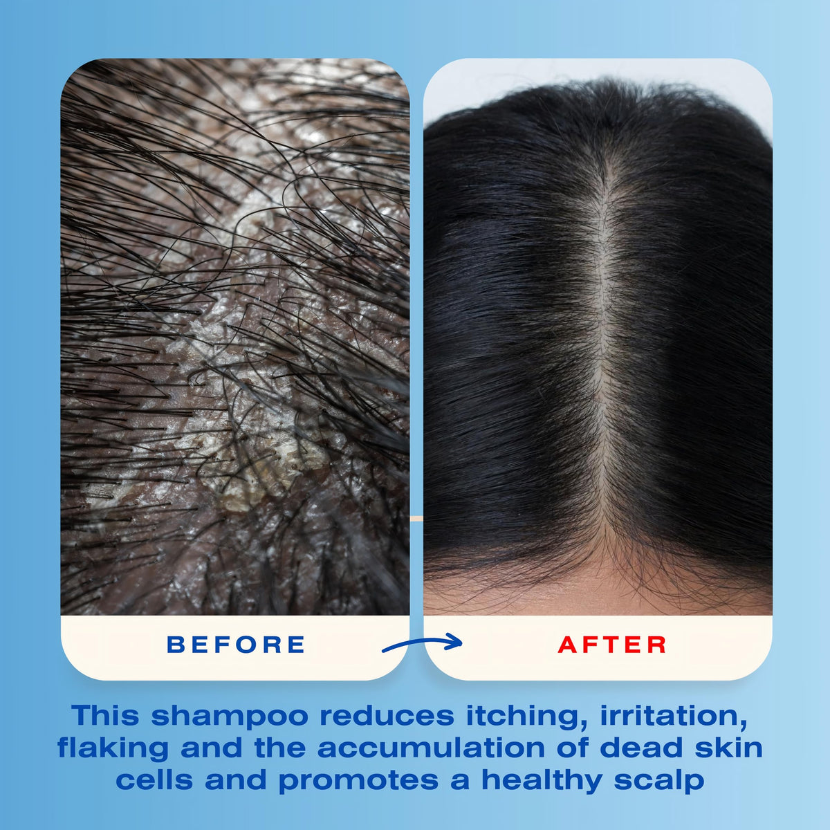 Woman rinsing Mediceuticals X-Folate shampoo to remove flakes