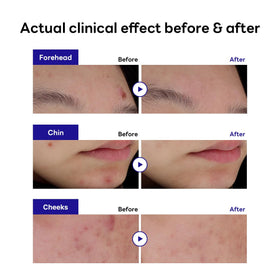 MEDIHEAL patch close-up texture showing smooth hydrocolloid surface and absorbency