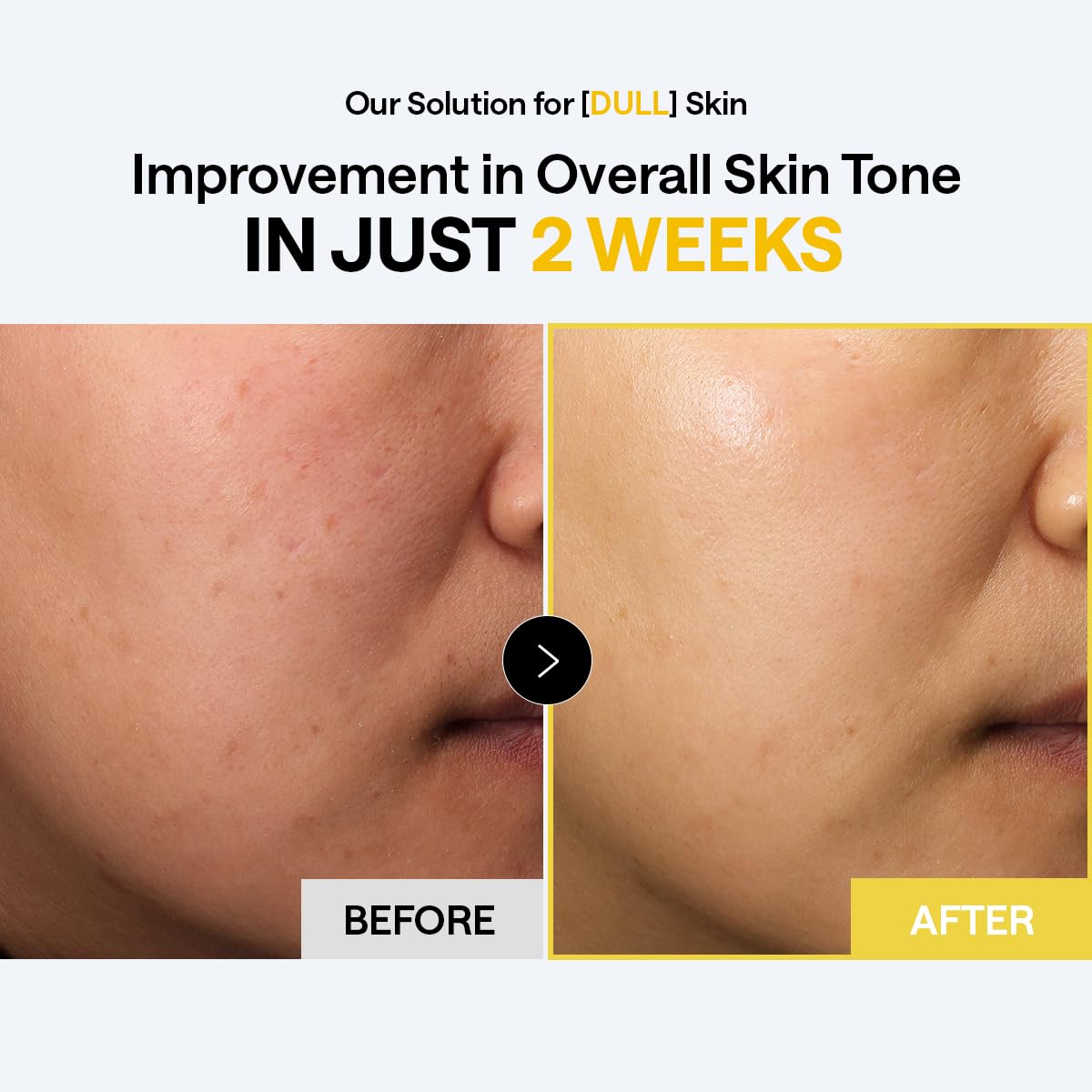 MEDIHEAL pad applied as spot mask on cheek to target dark spots