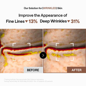 MEDIHEAL patch on smile line showing targeted wrinkle smoothing result